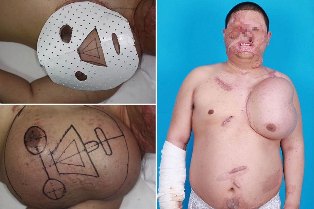 Man has growing another ‘face’ on his chest