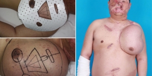 Man has growing another ‘face’ on his chest