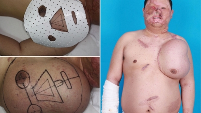 Man has growing another ‘face’ on his chest