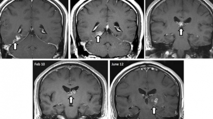 Man saved from the tapeworm which had been moving in his brain since four year