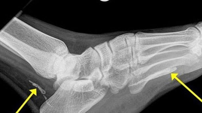 The worm which was stuck inside the man’s foot got successfully removed