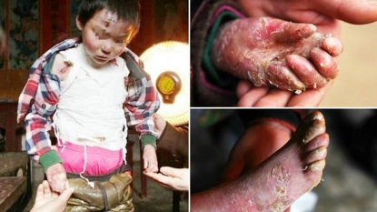 Boy of eight suffers skin fall everyday because of a rare health condition