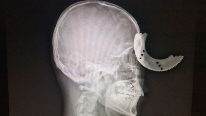 Man cheats death after the metal circular blade cuts into his skull