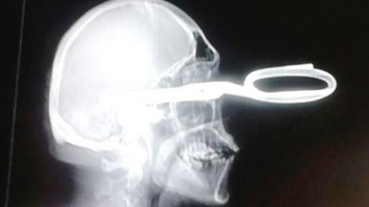 Man with scissor in his skull asked calmly to the hospital staff for help