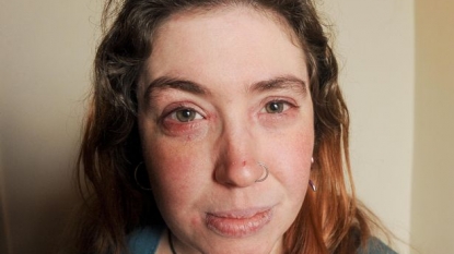 Woman was rushed to hospital after her eyes exploded during a driving lesson