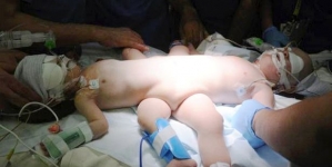 Conjoined babies who shared digestive system now became two separate babies