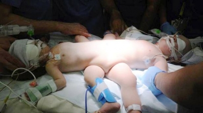 Conjoined babies who shared digestive system now became two separate babies