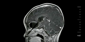 Parent left stunned after discovering a chopstick inside their kid’s brains