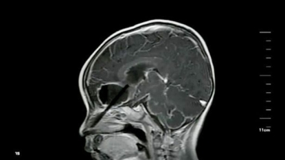 Parent left stunned after discovering a chopstick inside their kid’s brains