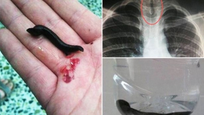 Doctors removed the growing leech inside the boy’s body