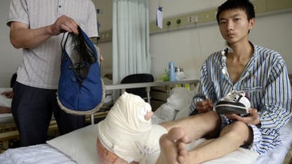 Man’s foot swells to become 17 inch long and shockingly it’s still growing