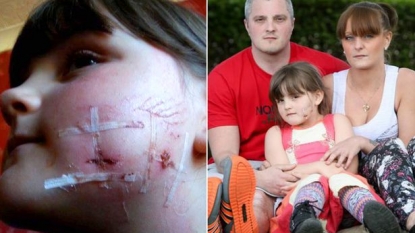 Six year old girl left with scars for life after she was attacked by a dog