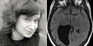 Woman who has a lemon-sized hole in her brain, wrote a book about her experience