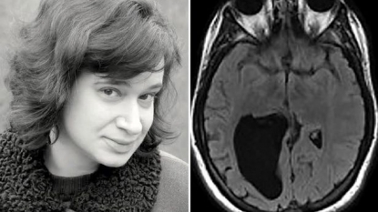 Woman who has a lemon-sized hole in her brain, wrote a book about her experience