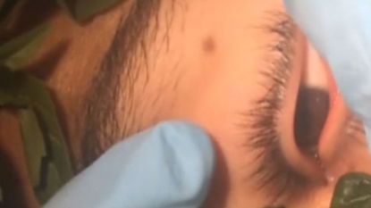 Doctors found a worm inside a boy’s eyes