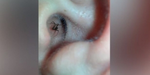 Man films a spider crawling out of ear canal