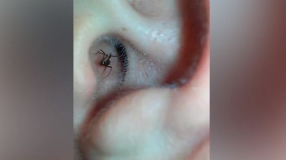 Man films a spider crawling out of ear canal