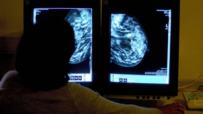 Breast screening benefits overstated