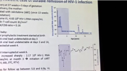 Doctors studying rare case of AIDS remission