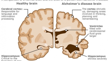 Eli Lilly: Experimental Alzheimer’s drug shows some benefit