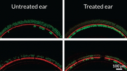 Gene therapy shows hope for the deaf to hear again | Zee News