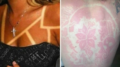 Sunburn ‘Tattoos’: unsafe, Not Decorative