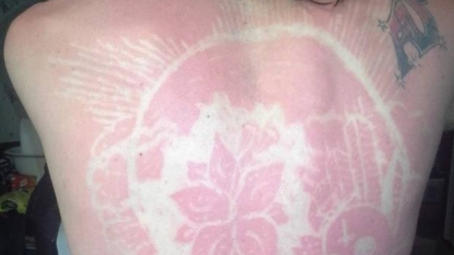 #SunburnArt? Experts warn against unsafe social media trend – KPTV