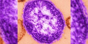 Measles kills first patient in 12 years