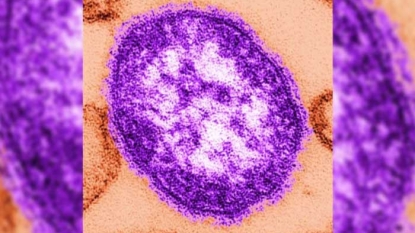 Measles kills first patient in 12 years