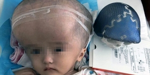 Chinese Girl Becomes World’s First To Receive Full Skull Reconstruction Via 3D