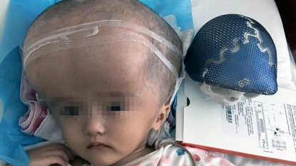 Chinese Girl Becomes World’s First To Receive Full Skull Reconstruction Via 3D