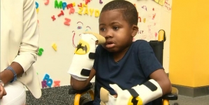 Boy who lost hands to infection gives double thumbs up after surgery