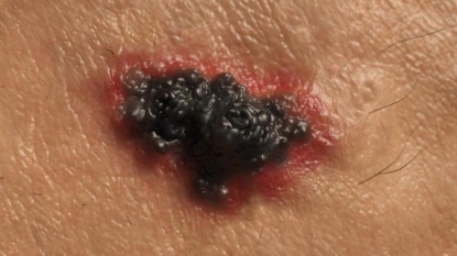 41-29 FDA Approved Odomzo in Basal Cell Carcinoma