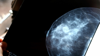 JAMA: Mammography does not reduce breast cancer deaths, could result in