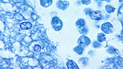 Brain-eating amoeba blamed in death