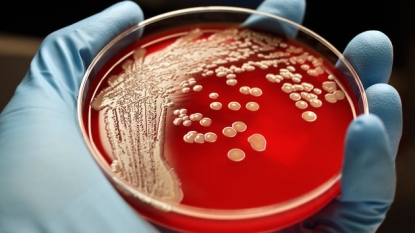 Superbugs out to infect more people in the US, study claims