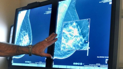 Earliest breast cancer risky for some women, study suggests