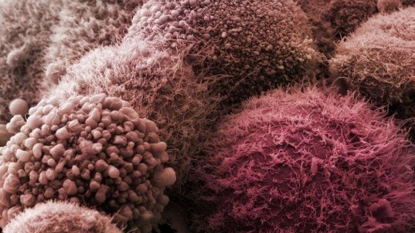 Cancer drug flushes dormant HIV out of hiding in the body