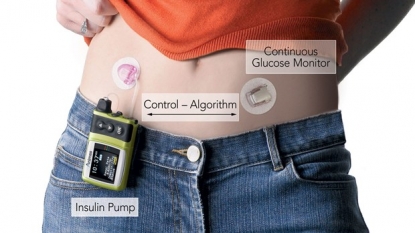 Artificial pancreas provides real-time monitoring of insulin