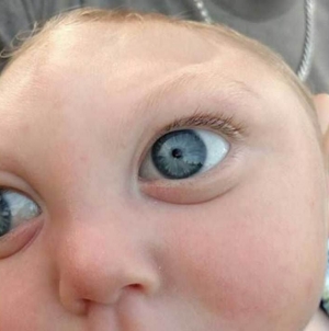 Baby born without part of skull defies odds, celebrates 1st birthday