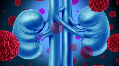 Drug targeting immune system shown to help kidney cancer patients