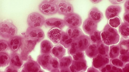 Drug resistant gonorrhoea triggers national alert