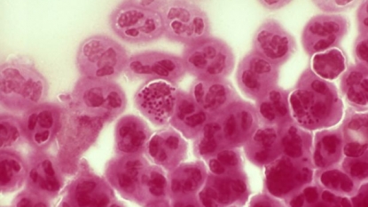 Drug resistant gonorrhoea outbreak triggers national alert