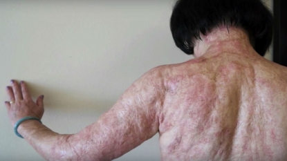 ‘Napalm girl’ documented second time; begins laser treatment for burn scars