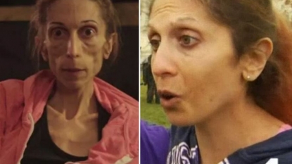 Anorexic woman who weighed 44 pounds makes incredible recovery 5 months after