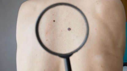 FDA approves drug for use in combination therapy for advanced melanoma