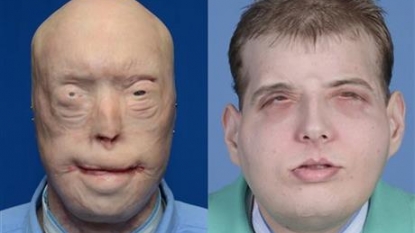 Firefighter gets a new life after ‘most extensive’ face transplant in history