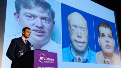 Injured firefighter gets most extensive face transplant ever