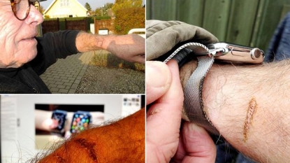 Man Blames The Apple Watch For Burns On His Wrist