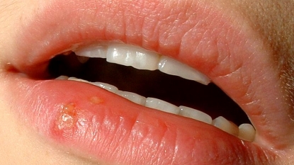 Two-thirds of the world’s population has Herpes